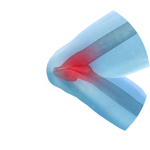 patologie-ginocchio-protesi